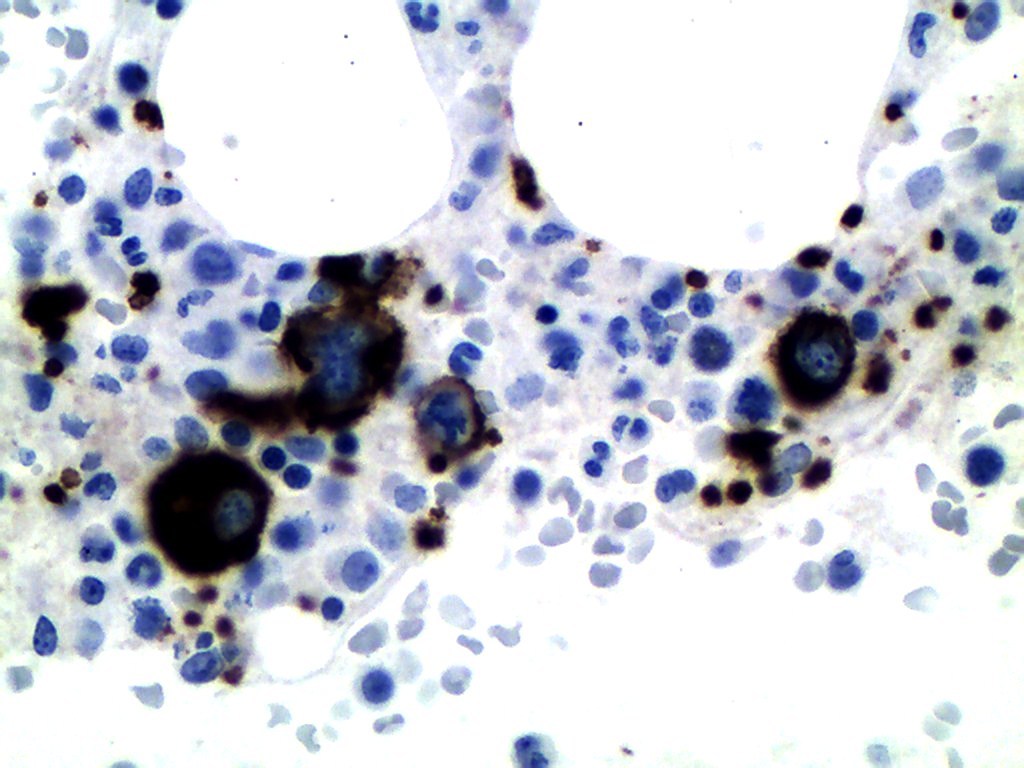 Figure 3: Small megakaryocytes with hypolobated nuclei highlighted by CD42b immunostain